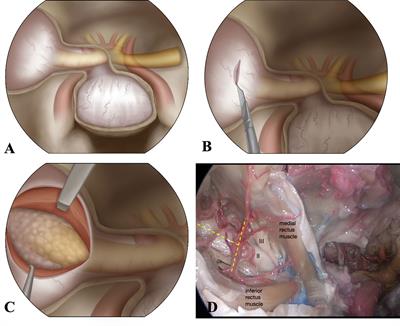 Endoscopic Endonasal Intraconal Approach for Orbital Tumor Resection: Case Series and Systematic Review